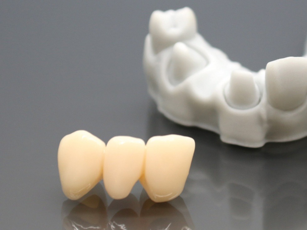 Permanent crowns, ceramic filled. High strength, applications in the field of dentistry, quality high-end 3D printing casting resin / 3D printing consumables